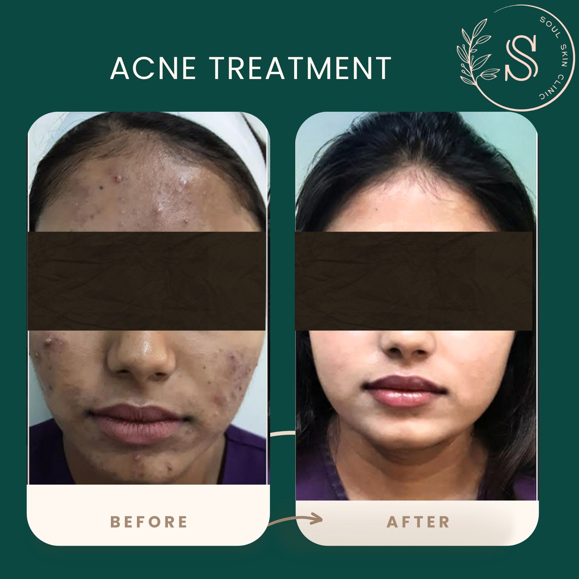 Acne TREATMENT BEFORE AFTER