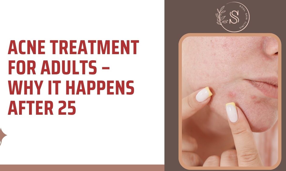 Acne Treatment for Adults – Why It Happens After 25