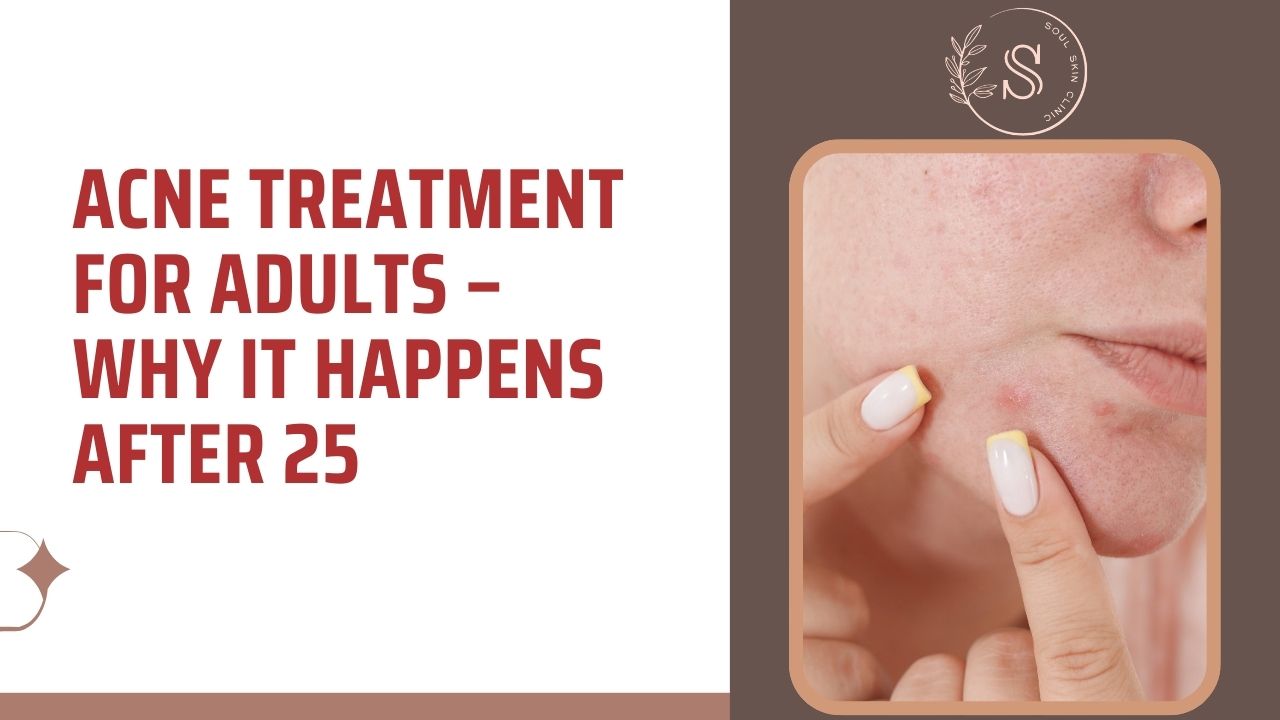 Acne Treatment for Adults – Why It Happens After 25