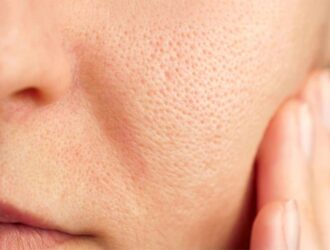 Open Pores Treatment in Anna Nagar |Soul Skin Clinic