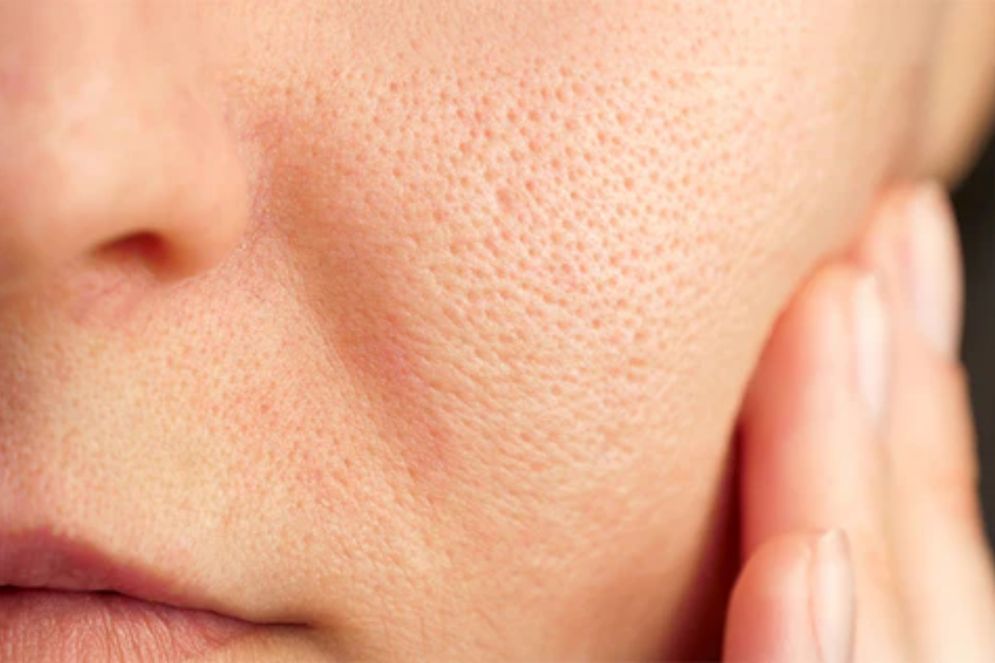 Open Pores Treatment in Anna Nagar |Soul Skin Clinic