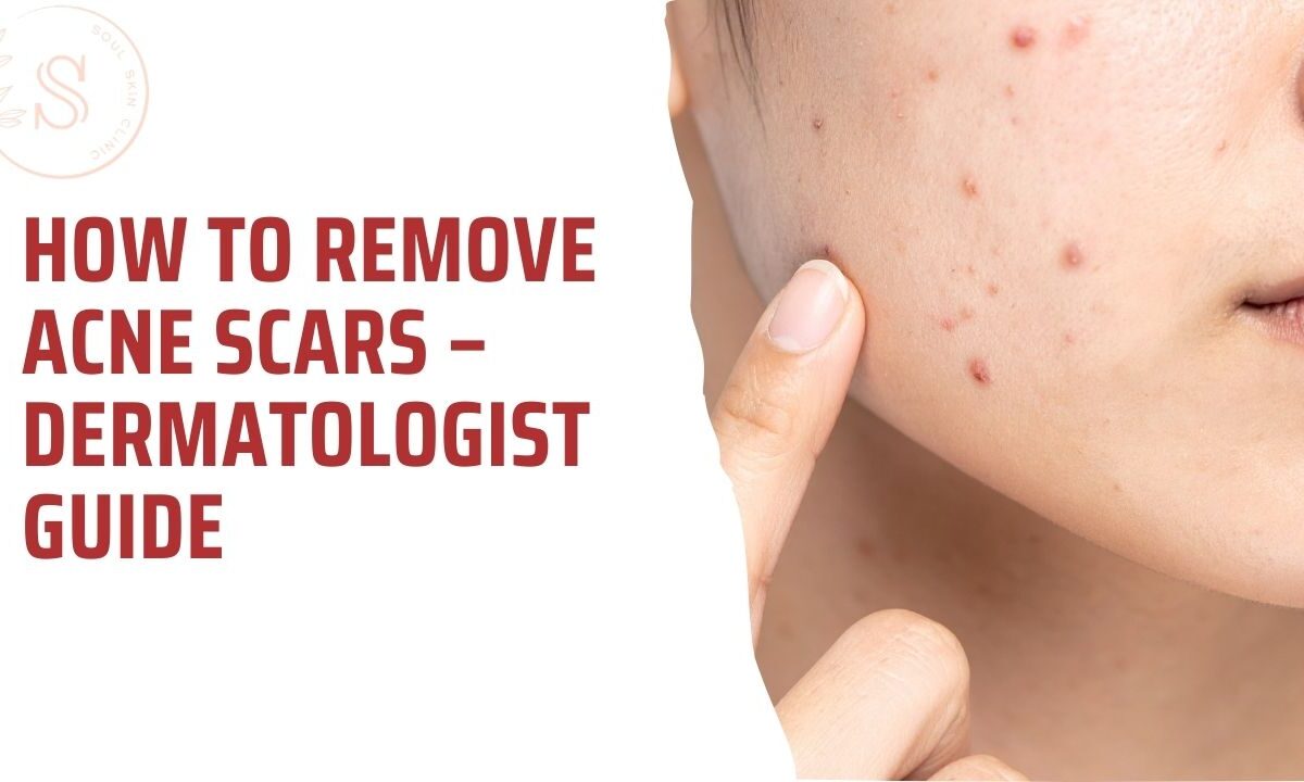 How to Remove Acne Scars – Dermatologist Guide in Chennai
