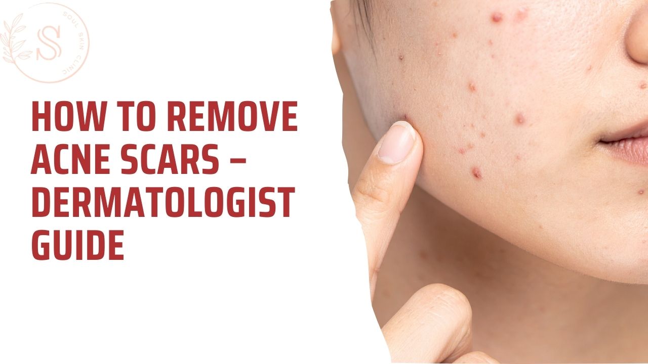 How to Remove Acne Scars – Dermatologist Guide in Chennai