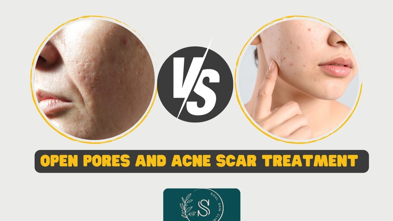 Open Pores and Acne Scars: Causes, Differences & Best Treatment