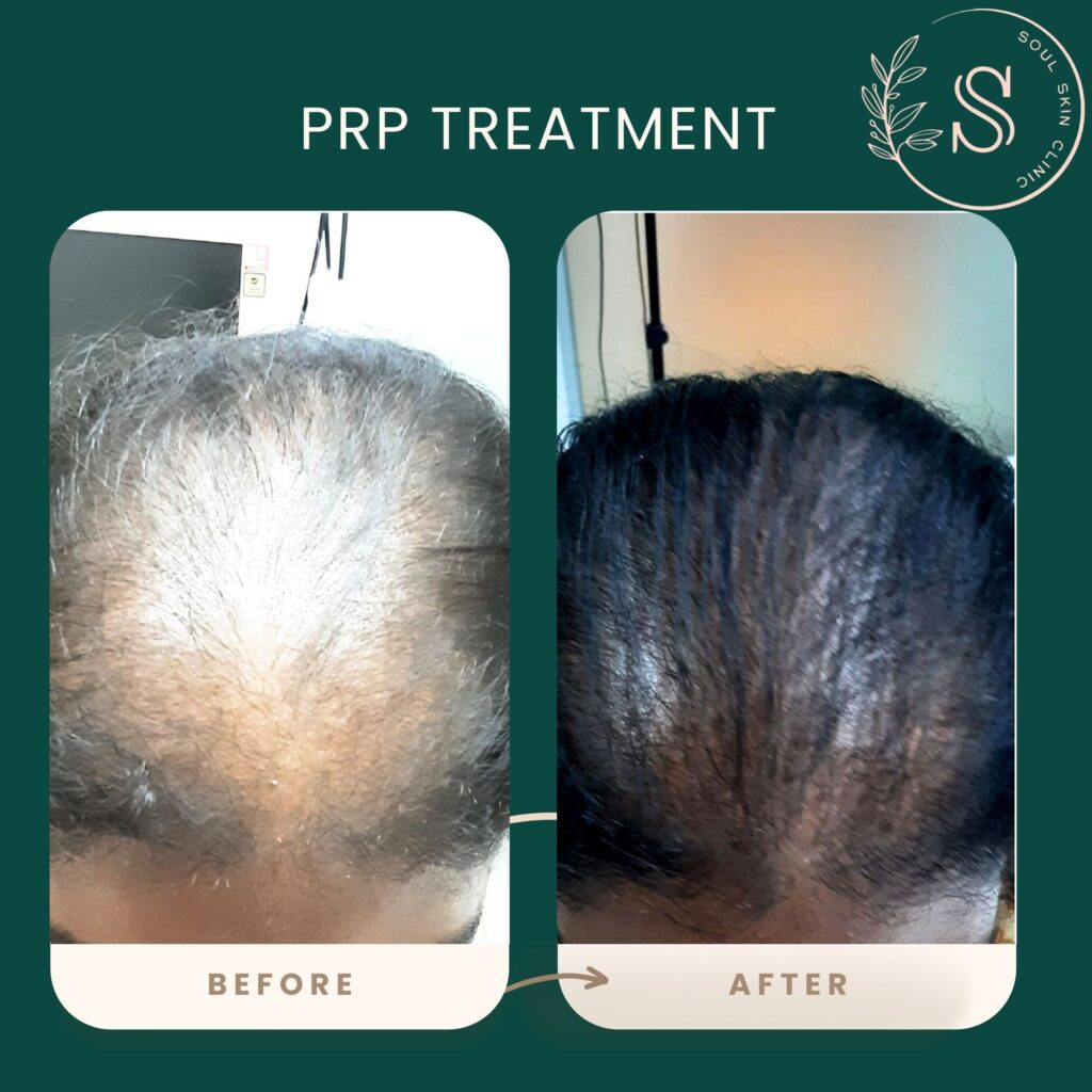 PRP TREATMENT BEFORE AFTER