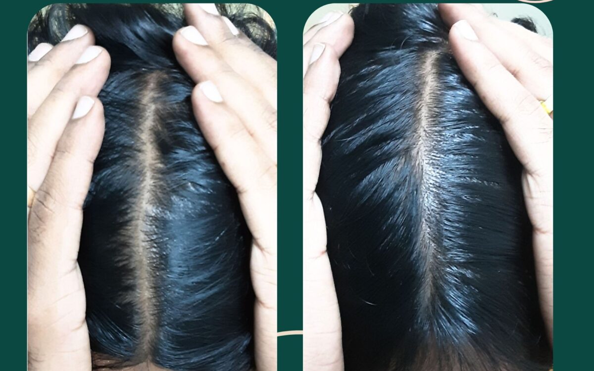 Why Is My Hair Falling Out Suddenly Female? before after