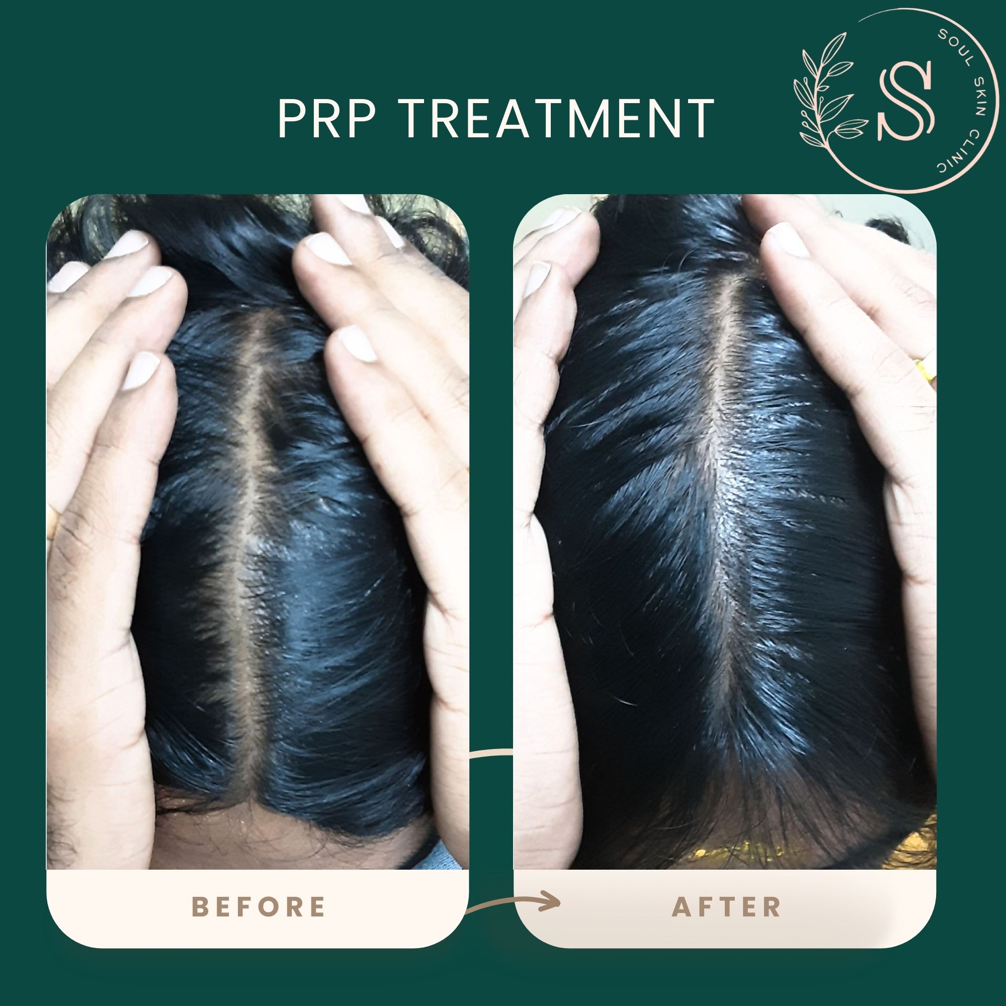 PRP Hair Treatment Cost in Chennai – Complete Guide