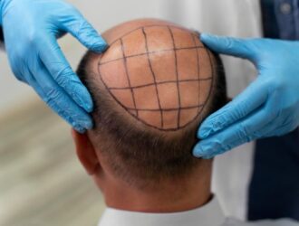 Hair Transplant Treatment in Anna Nagar | Soul Skin Clinic